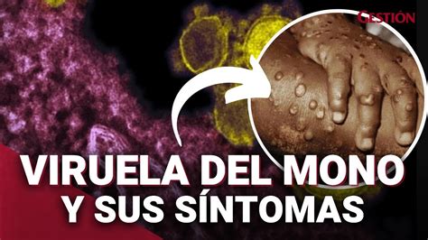 Viruela Del Mono Qué Es SÍntomas Y Cómo Se Contagia Esta Enfermedad