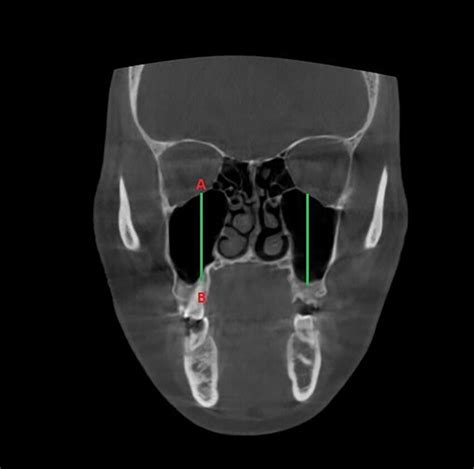 Measurement Of Maxillary Sinus Height In Coronal Section Point