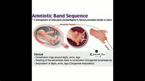 💠 Amniotic Band Sequence 💠 Youtube