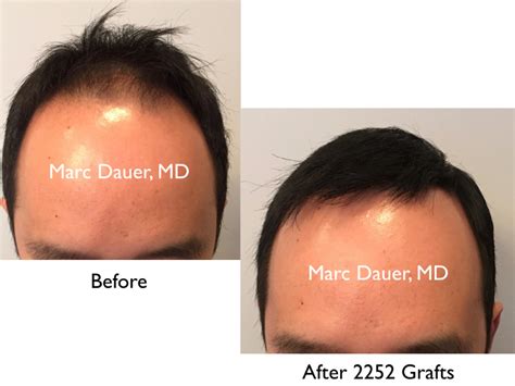 Bad Hair Transplant Procedure | Marc Dauer, MD