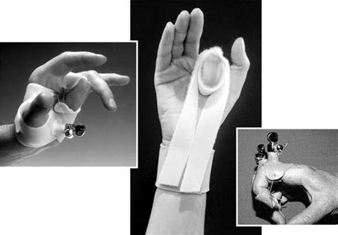 Static Progressive Splinting Journal Of Hand Therapy