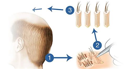 Follicular Unit Extraction Fue Hair Transplantation Wonder Medical