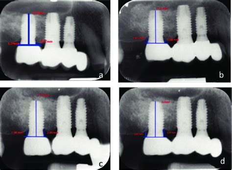 Periapical X Rays Showing The Measurement Of Bone Crest Level Both