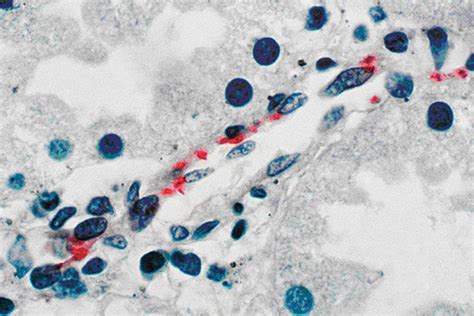 Figure 2 - Fatal Spotted Fever Rickettsiosis, Minas Gerais, Brazil - Volume 9, Number 11 ...