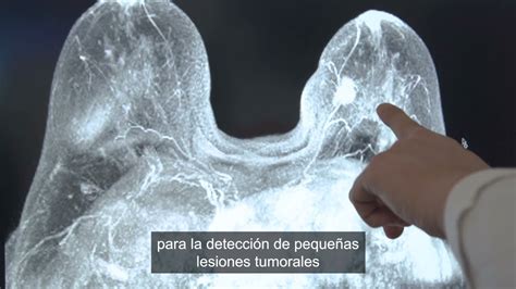 Cáncer de mama la resonancia clave para diagnósticos en pacientes