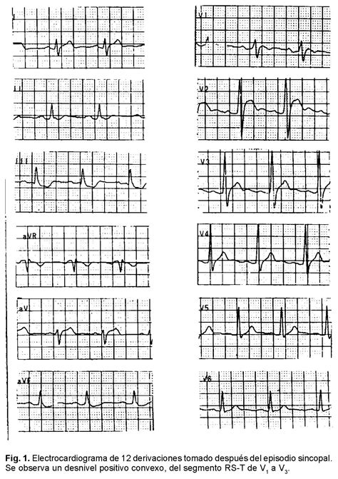 Alteraciones Electrocardiogr Ficas Durante El Esfuerzo En Un Paciente