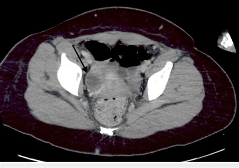 Axial Ct Chest Abdomen And Pelvis With Iv Contrast Download Scientific Diagram