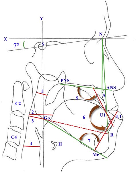 Cephalometric Landmarks And Linear Measurements Landmarks Nasion N