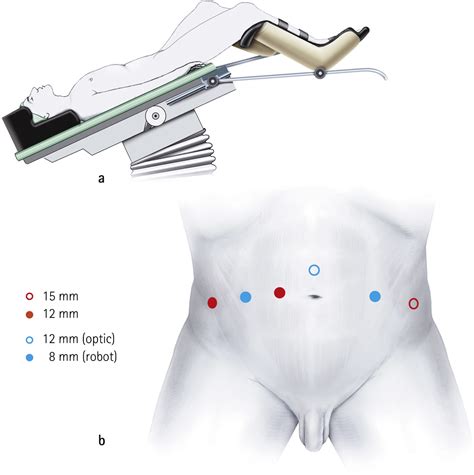 Robot Assisted Radical Cystectomy Description Of An Evolved Approach