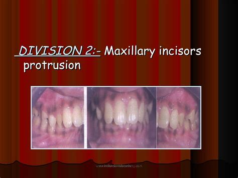 Malocclusion Certified Fixed Orthodontic Courses By Indian Dental