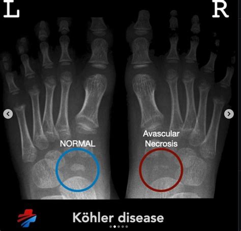 exams   kohler disease