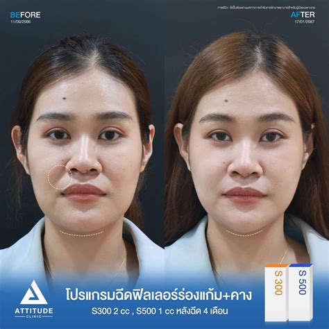 รีวิว Attitude Clinic ห้วยขวาง รีวิวโปรแกรมฉีดฟิลเลอร์ร่องแก้ม คาง