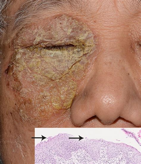 Localised Pemphigus Foliaceus Around The Eyes The Bmj