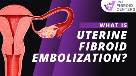 Watch How Ufe Uterine Fibroid Embolization Works Youtube