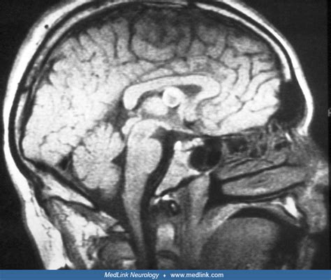 Colloid Cysts Medlink Neurology