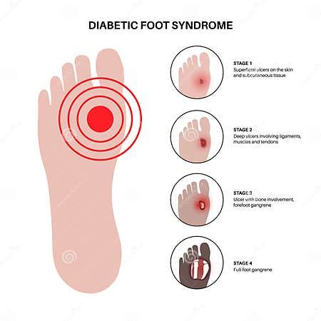 Diabetic Foot Ulcers stock vector. Illustration of patient - 287520846