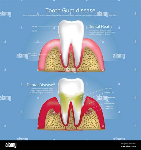 Human Teeth Stages Of Gum Disease Vector Illustration Stock Vector