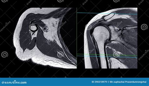 Magnetic Resonance Imaging Or Mri Of Shoulder Joint For Diagnostic