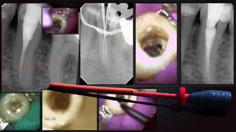 Minimally Invasive Endodontics Youtube