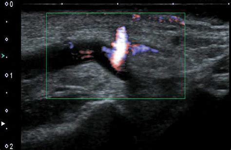 Color Doppler Ultrasonography Showing A Pseudoaneurysm Of The Radial