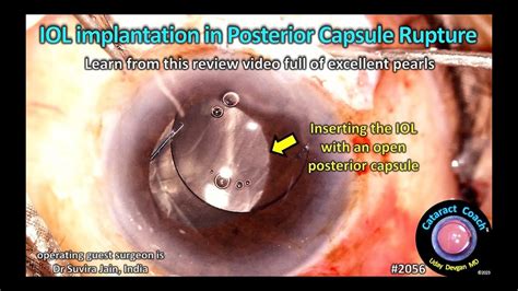 CataractCoach 2056 IOL Implantation In Posterior Capsule Rupture