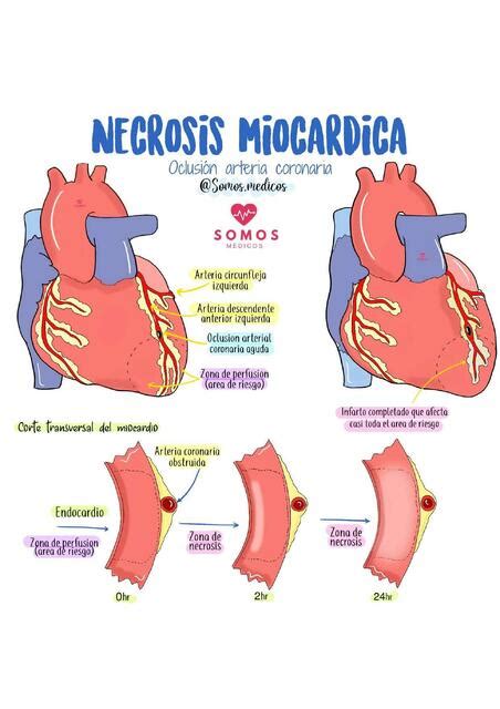 Necrosis Miocárdica Fanpage Somos Médicos uDocz