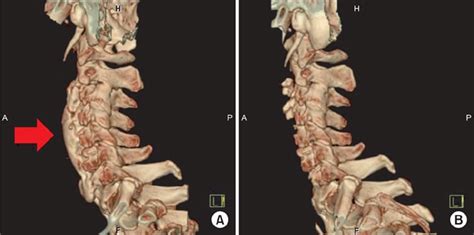 Dish (Diffuse Idiopathic Skeletal Hyperostosis)