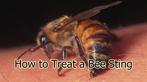 How To Treat A Bee Sting