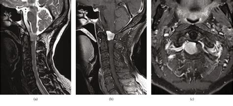 Figure From Angiomatous Meningioma In The Craniocervical Junction