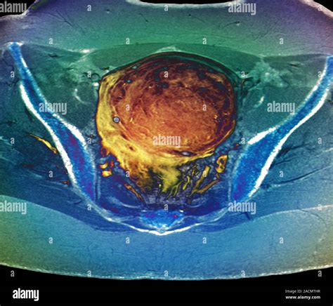 Útero Tumoral Color De Rayos X A Una Mujer De 36 Años Con Un Gran