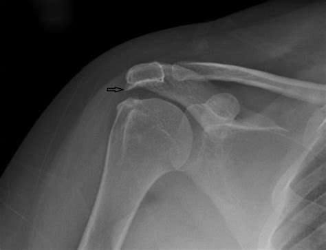 Osteophytebone Spur Shoulder Pain Differential Diagnosis