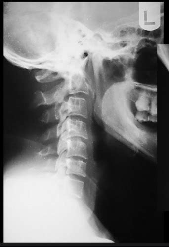 Cervical Anomalies Variants Flashcards Quizlet