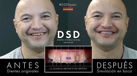 Est Tica Dental Inmediata Dsd Edgar Dise O Sonrisa Digital Dr