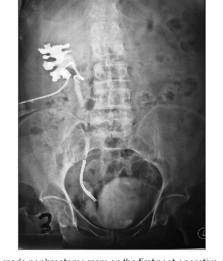 Figure 1 From Minimal Invasive Treatment Of Benign Anastomotic Uretero