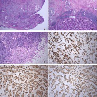 Histology And Immunohistochemistry Of Excised Tumor A Low Power Of