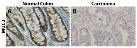 Immunohistochemistry Of MUC2 From Wang Et Al Oncology Letters 2017