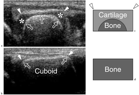 Derrame Articular Sinais De Sinovite O Que Isso Significa Em