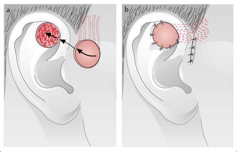 The Auricular Region Plastic Surgery Key