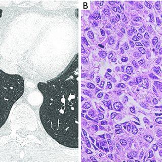 Chest CT Findings And Microscopic Findings Of The Lung Tumor A CT