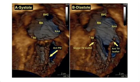 My Approach To Three Dimensional Echocardiography For