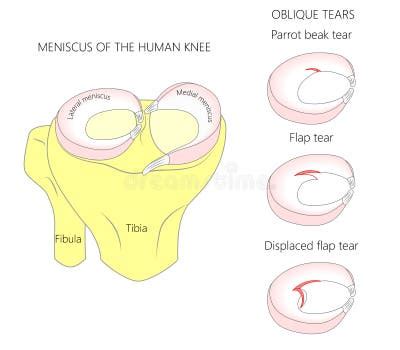 Lateral Meniscus Stock Illustrations – 371 Lateral Meniscus Stock ...