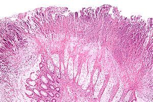 Pseudomembranous colitis - Libre Pathology