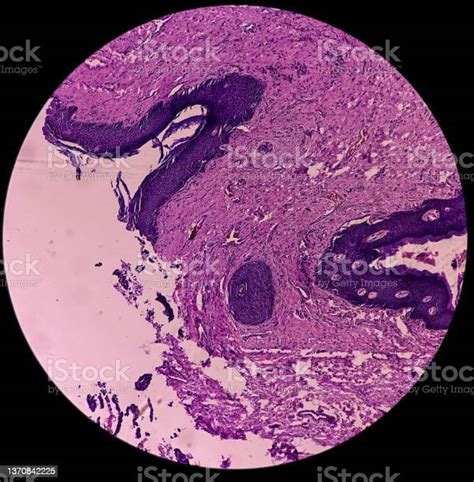 Hidradenoma Papilliferum Benign Skin Tumor Rare Benign Neoplasm