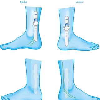 Diagram demonstrating positioning of Geko™ device for active and sham ...