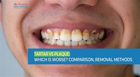 Tartar vs Plaque: Which is Worse? Comparison, Removal Methods