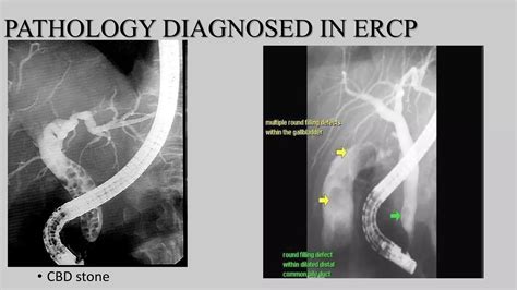 Procedure Of Ercp And T Tube Cholangiography Ppt