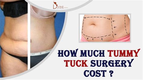 How Much Does Tummy Tuck Surgery Cost Plastic Surgery In India