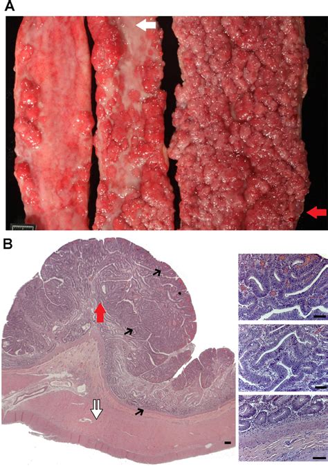 N14 77 Represents A Rare Case Of Extreme Intestinal Polyposis In The Download Scientific