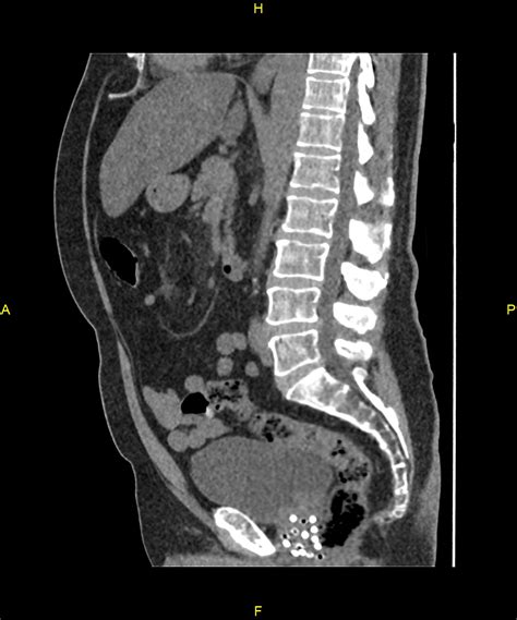 Prostate Brachytherapy Beads Image