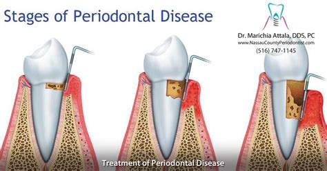 Periodontal Disease Treatment Dr Marichia Attalla Dds Pc